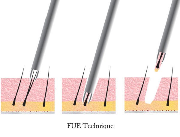 Total Male Hair Loss Treatment