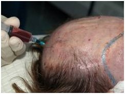 PRP Treatment for Hair Loss