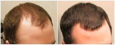 PRP Treatment for Hair Loss